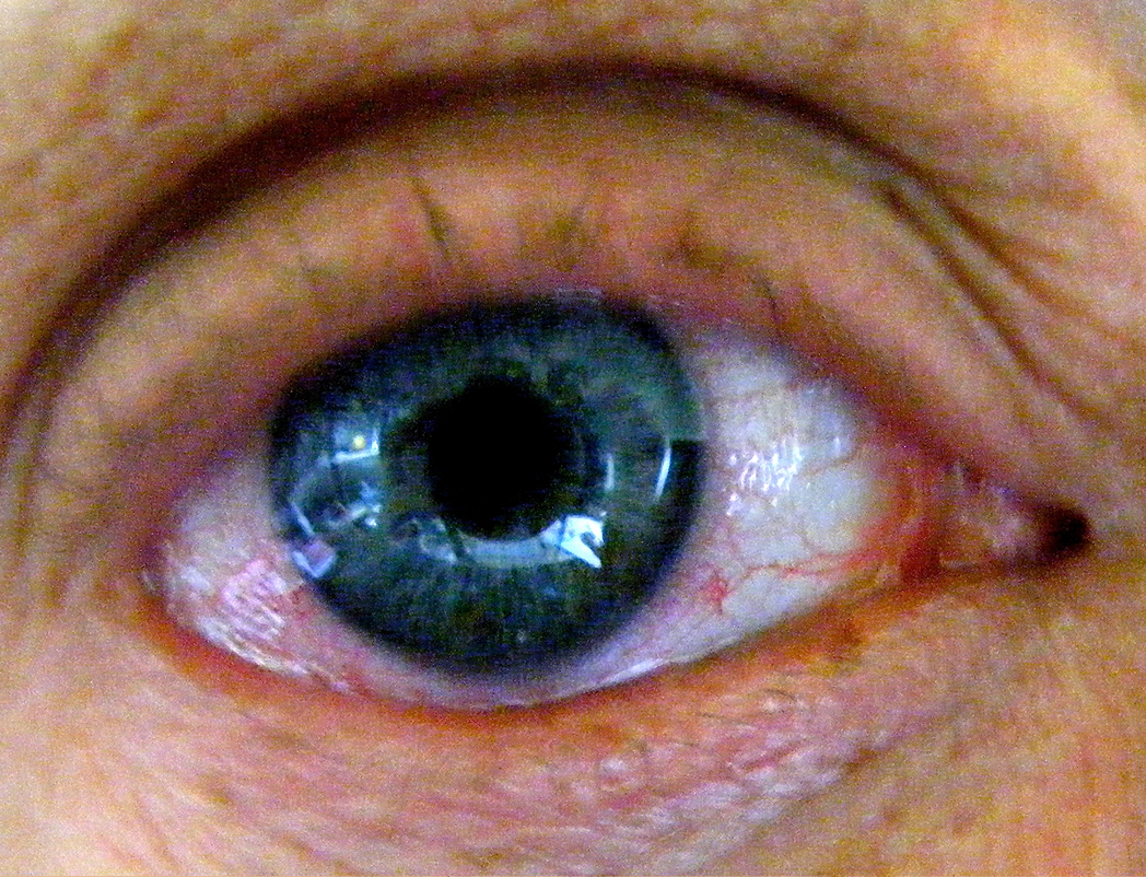 What to do if you get hand sanitizer in the eye