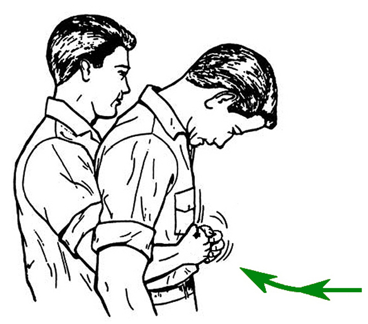 Heimlich maneuver remains best technique for relieving choking