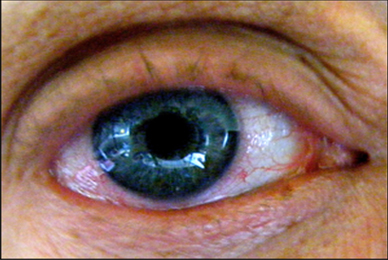 What to do for something in the eye