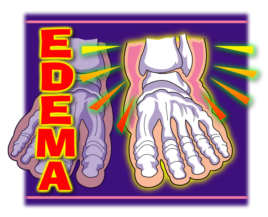Swollen feet should be checked out