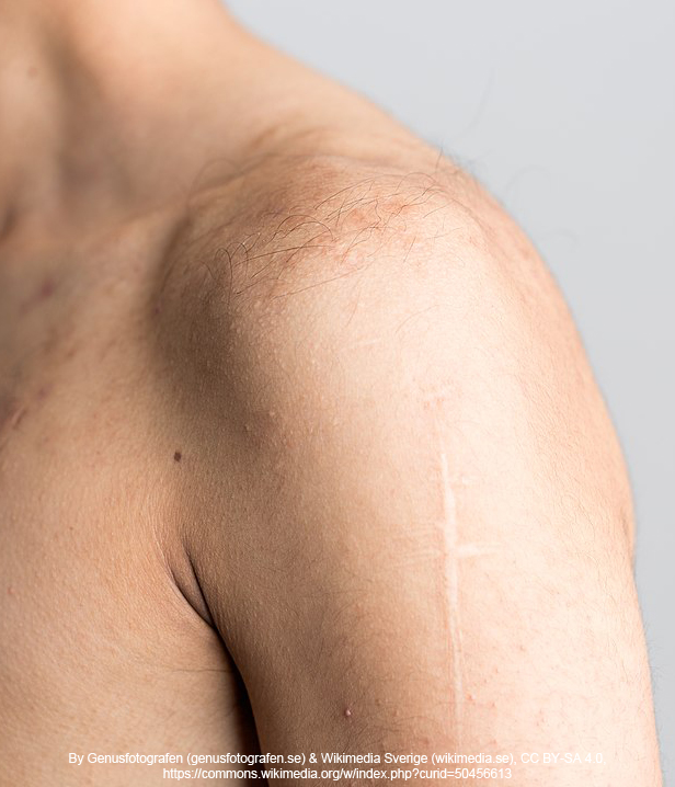 Preventing shoulder injuries with proper lifting techniques